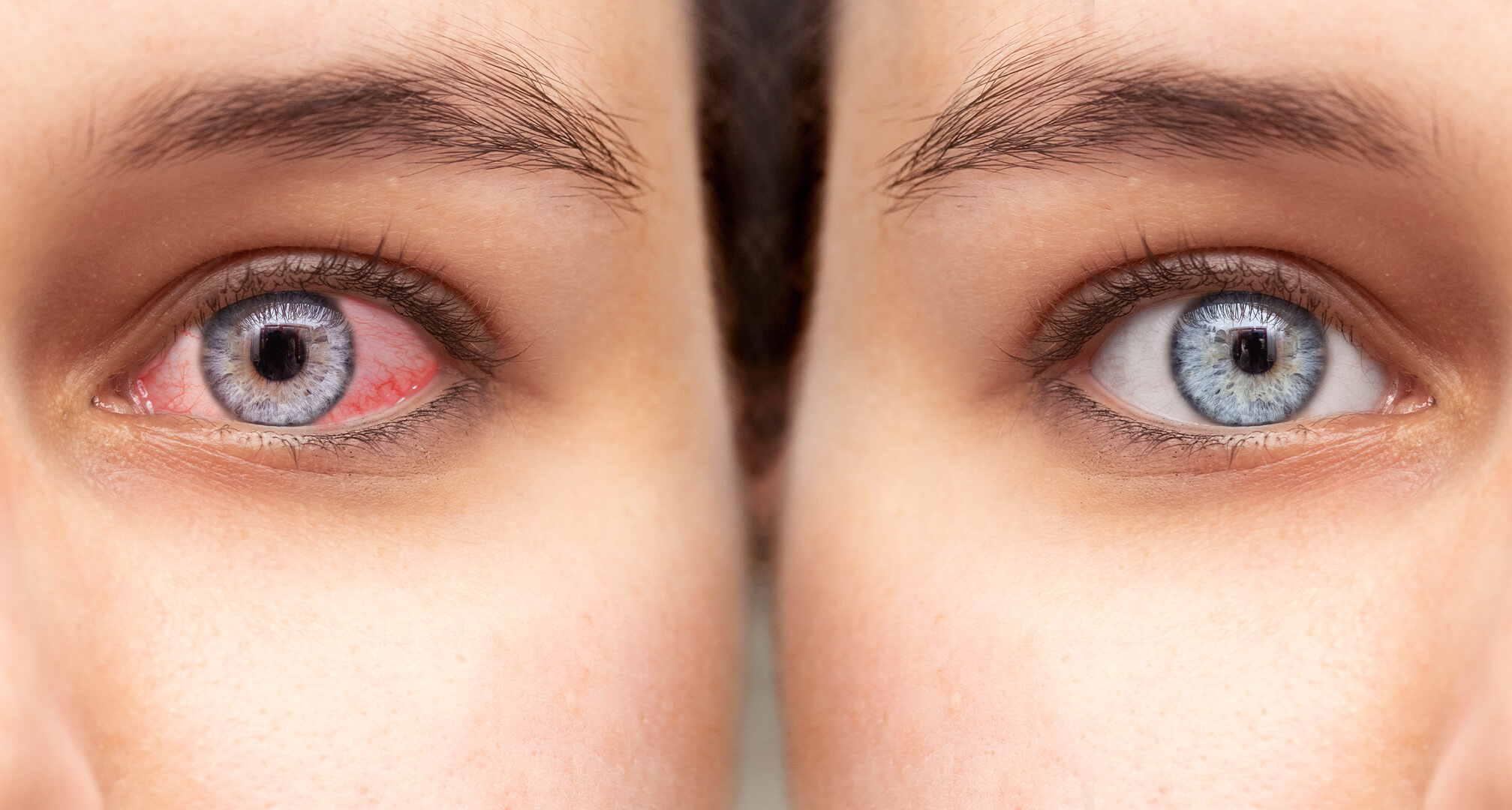 Nahaufnahme zweier Augen nebeneinander, ein rotes trockenes Auge links und ein gesundes Auge rechts